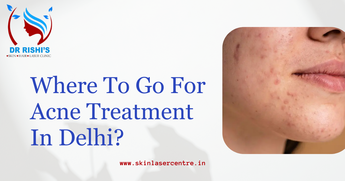 Where To Go For Acne Treatment In Delhi?